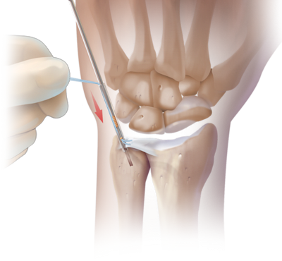 Reparo artroscópico TFCC sem nós com PushLock<sup>®</sup>