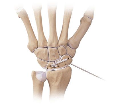 DX SwiveLock<sup>®</sup> SL Anchor for Scapholunate Ligament Repair