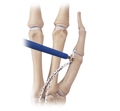 Reconstrucción del ligamento colateral del pulgar con DX SwiveLock<sup>®</sup> SL