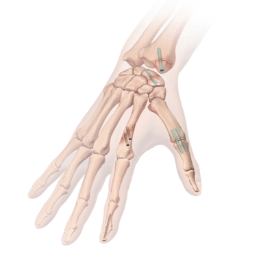 Hand/Wrist Fracture Repair