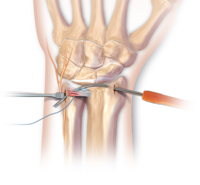 Arthroscopic TFCC Repair using the Micro SutureLasso™ (Inside out / Outside in)
