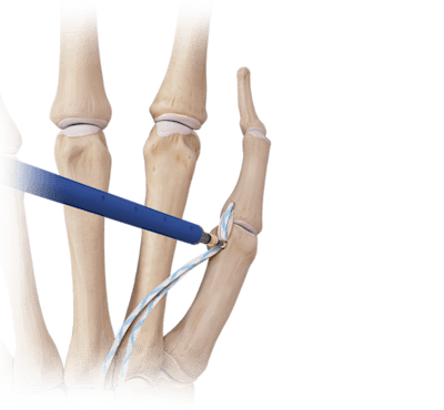 Aumentación en la reparación de ligamentos de mano y muñeca con <em>Internal</em>Brace™