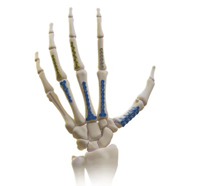 Umfassendes Mini-Fixierungssystem (Hand und Handgelenk)