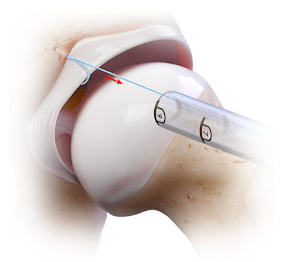 Labral Fixation