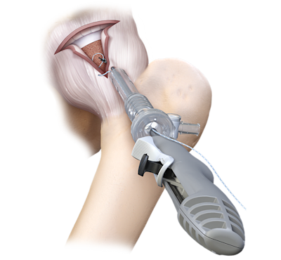 CapsuleStitch™ Suture Passer