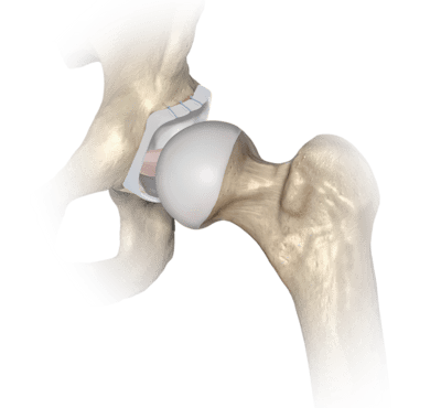 SutureTak<sup>®</sup> Suture Anchor