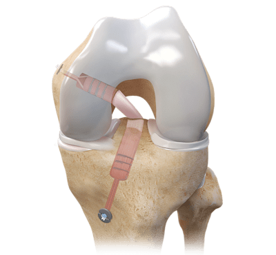 PCL Reconstruction 