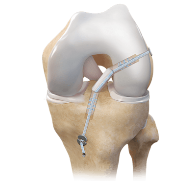 Allograft ACL Reconstruction