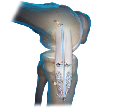 Medial Collateral Ligament (MCL) Repair 