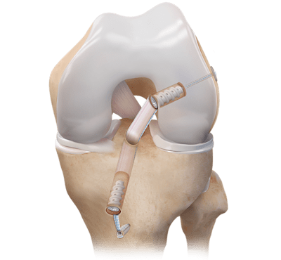 ACL-BTB-Transplantatfixierung