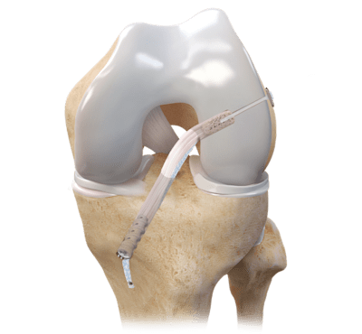 ACL BTB Graft Fixation