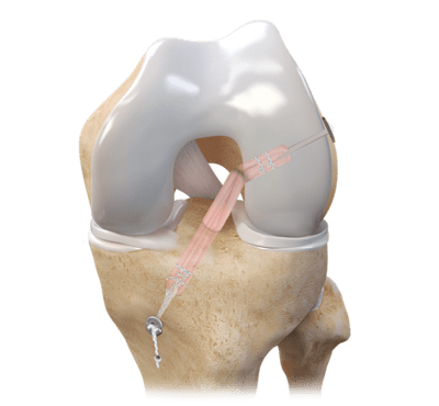 All-Inside ACL Reconstruction / FlipCutter<sup>®</sup>  III Reamer