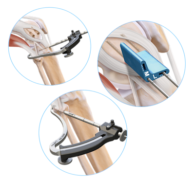 Anatomic Collateral Ligament Reconstruction