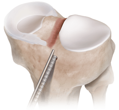 Técnica de transplante de menisco Dovetail/Slot