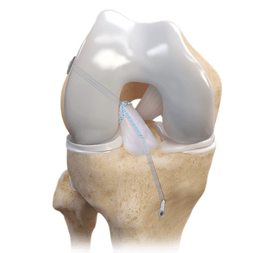 ACL-Refixation