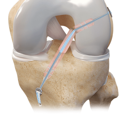 Arthrex - ACL Reconstruction