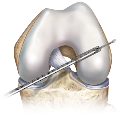 Preparo do soquete femoral portal medial