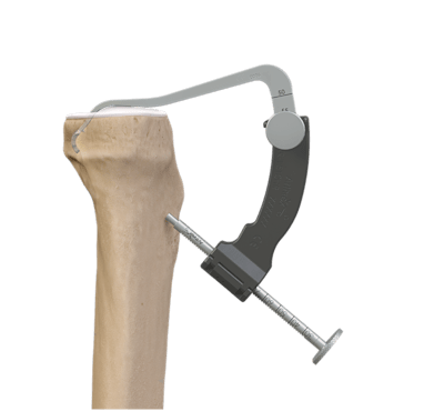 PCL Soft-Tissue Graft Fixation