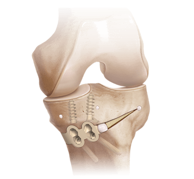 Osteotomia tibial proximal