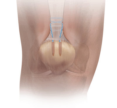 Quad Tendon Repair with PARS System Technique