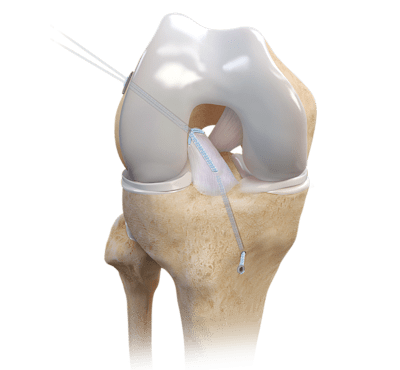 Repair TightRope® Implant With FiberRing™ Sutures