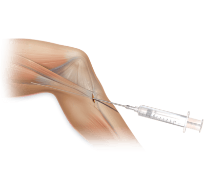 Hamstring Donor Site Delivery Tube