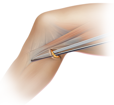 Hamstring Graft Harvest and Preparation Instruments