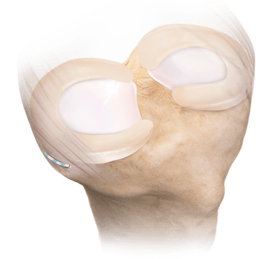Arthrex - Meniscus Repair Rasp - AR-4130