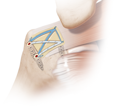 Matriz de refuerzo Arthrex DX