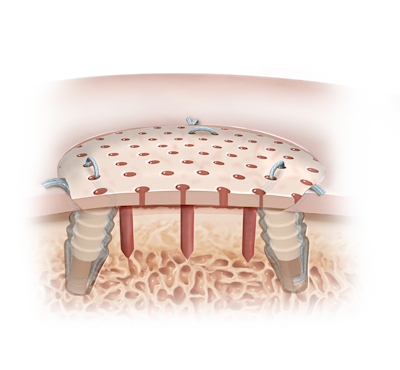 Aloenxerto osteocondral viável Cartiform<sup>®</sup>