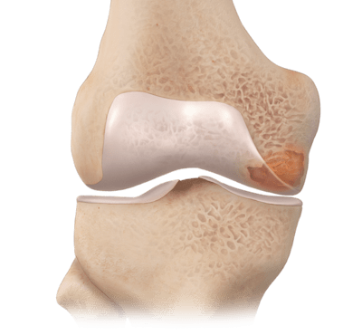 Técnica intraóssea BioPlasty<sup>®</sup> (IOBP) 