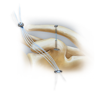 Técnica AC TightRope<sup>®</sup>