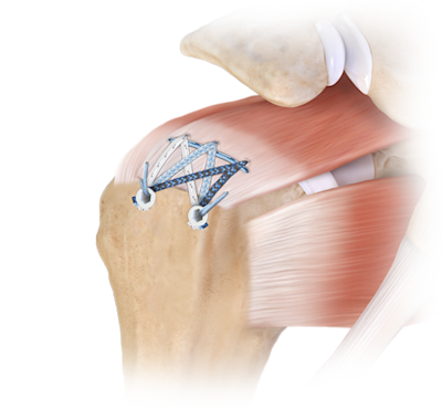 Knotless Rotator Cuff Repair