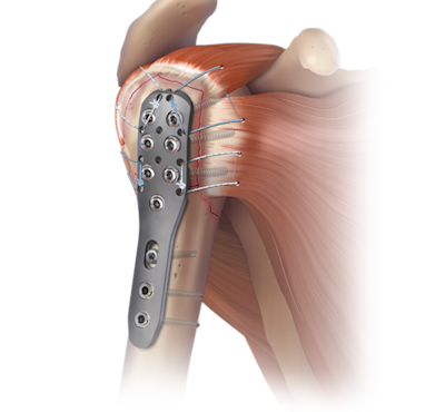 Reparación con SuturePlate™ para el húmero