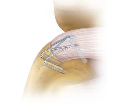 SutureBridge™ Double Row Technique