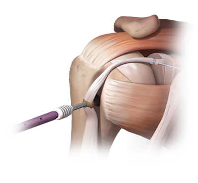 Técnica SwiveLock<sup>®</sup> para tenodesis