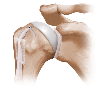 Arthrex - Proximal Tenodesis Implant System (Includes: Proximal ...