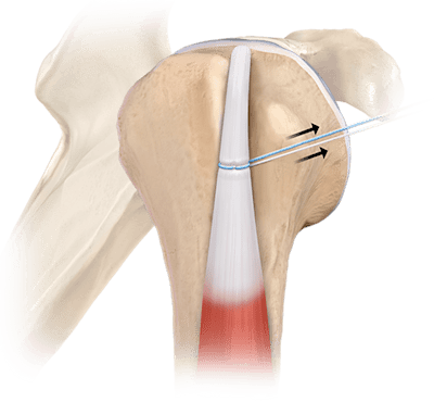 Knotless FiberTak®-Bizepstenodese 