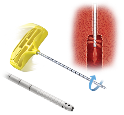 Agulhas roscadas de recuperação Spine Vortex™