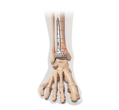 Fixação interna para fratura distal da tíbia/pilão