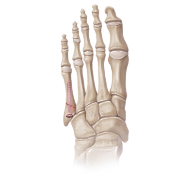 Jones Fracture Repair