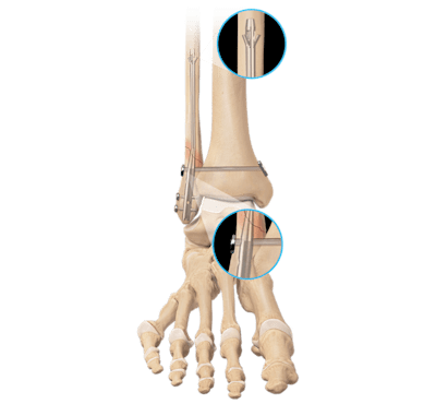 Fractura de tobillo