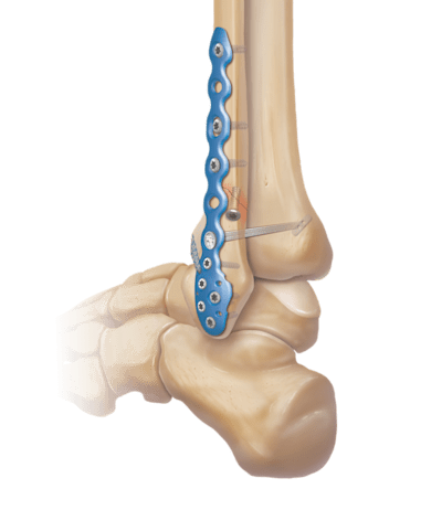 Sistema de titanio para fracturas de tobillo