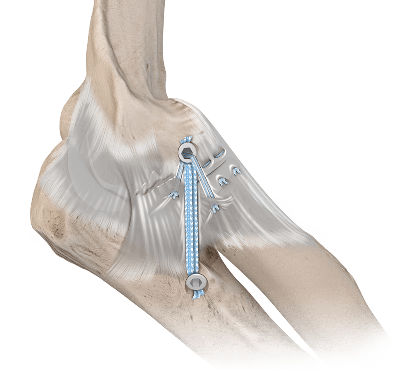 Posterior Lateral Rotary Instability After Dislocation