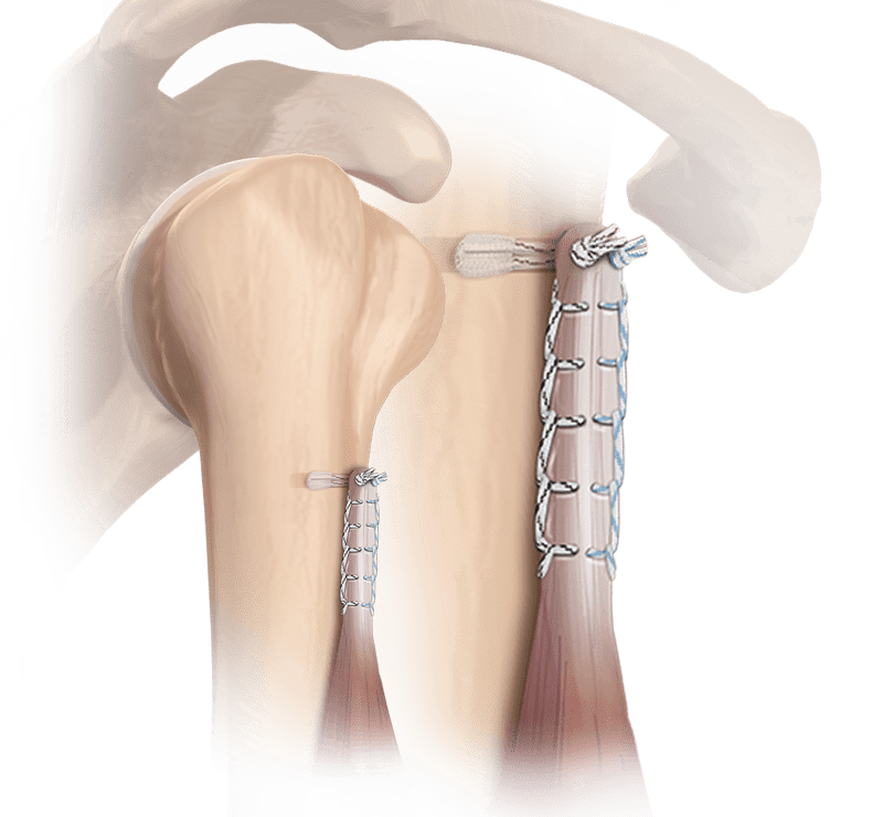 FiberTak<sup>®</sup> Biceps Tenodesis Technique