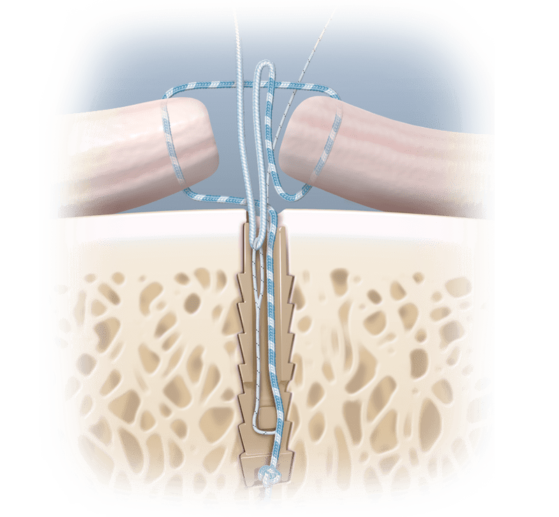 Técnica de reparación abierta SutureTak<sup>®</sup> sin nudos