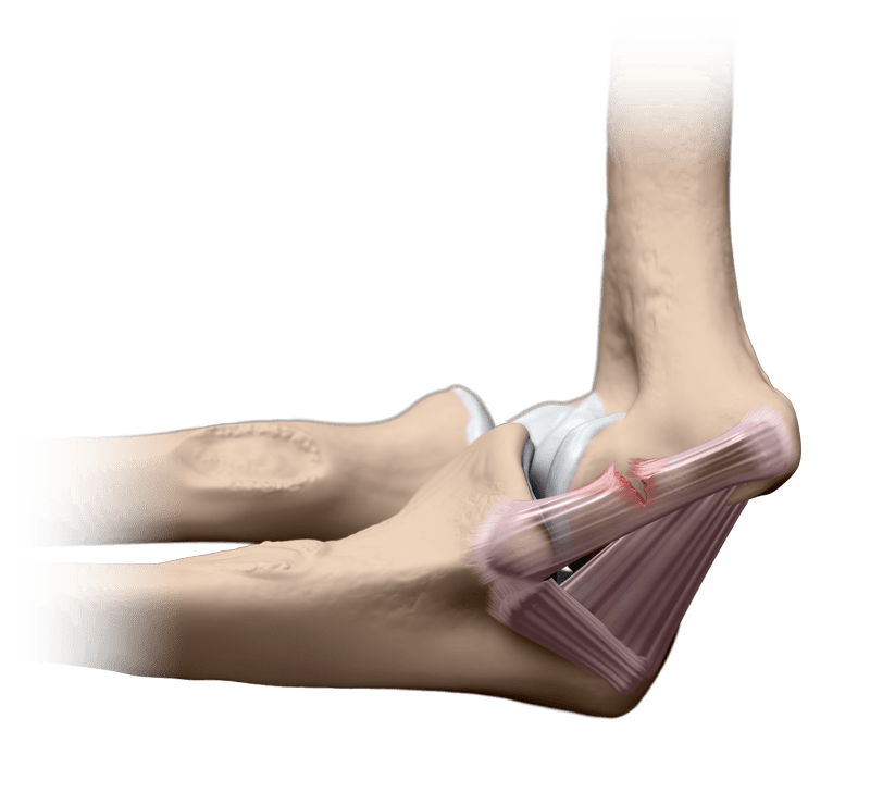 Ruptura do ligamento colateral ulnar