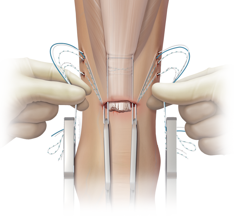 PARS SutureTape Technique for Achilles Rupture