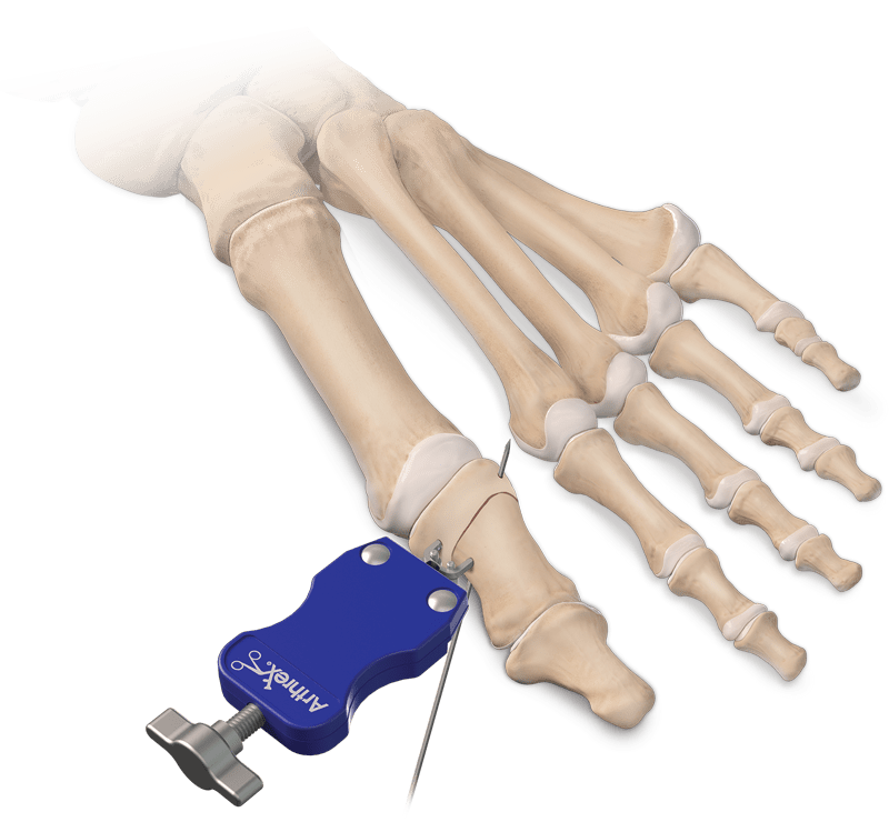 Osteotomía de Akin