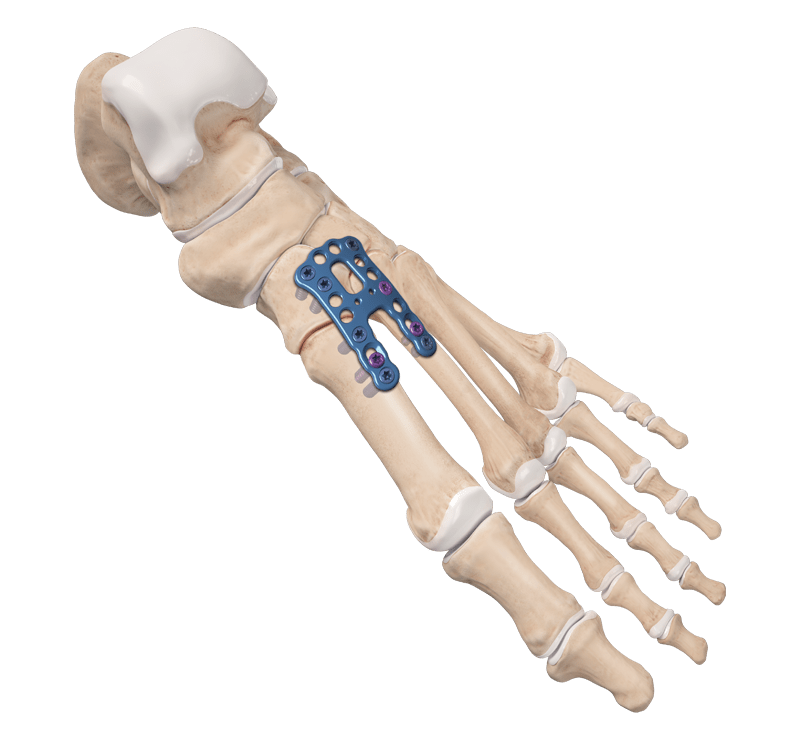 Lisfranc-Arthrodese